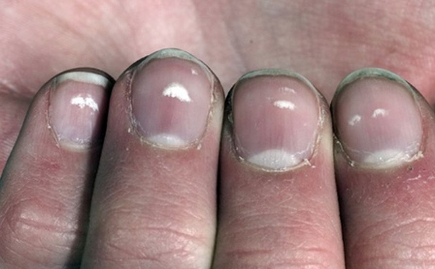 what-do-white-spots-on-your-nails-tell-about-your-health-it-is