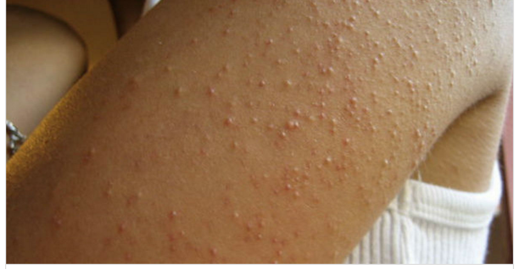 She Develops Itchy Red Bumps All Over Her Arms But No One Knew It Was 